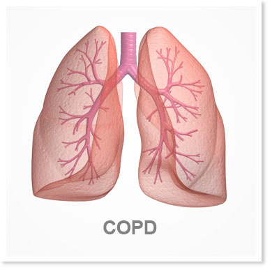 Plaatje longen COPD